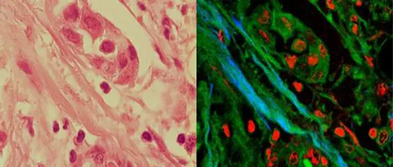 Left: Cancer Biopsy Stain. Right: Image of the Cancer Strain using CARS, TEPS and SHG Microscopy